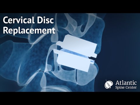Cervical Disc Replacement