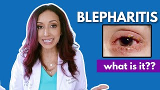 What Is Blepharitis? Eye Doctor Explains