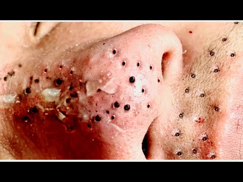 Mitesser und Pickel: Wie wichtig es ist, Ihre Haut von einem Fachmann reinigen zu lassen. BETRACHTEN