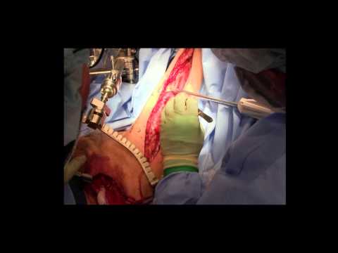 Gracilis Muscle Flap For Urologic Reconstruction