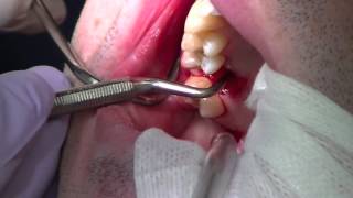 Physics Forceps Upper Molar Tooth Extraction, Cytoplast Barrier &amp; Grafting