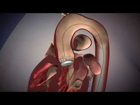 TAVR: Edwards, Sapien Aortic Valve Deployment