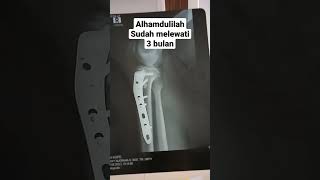 Download lagu operasi patah tulang pasang pen #videoshorts #shorts #shortsfeed #shortsyoutube #shortsvideo mp3