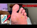 EXTREMELLY SATYSFYING CORNS DEBRIDEMENT
