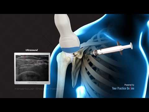 Intraarticular Shoulder Injection
