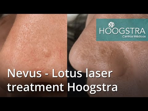 Nevus - Lotus laser treatment Hoogstra (22014)