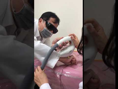 王正坤醫師帶著藝群眼睛來除疤 脈衝光