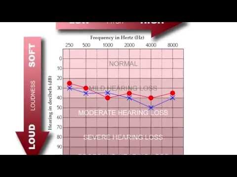 How to Read an Audiogram