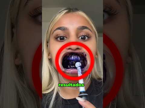 ¡Se excedió con el blanqueamiento dental! 😲 #shorts