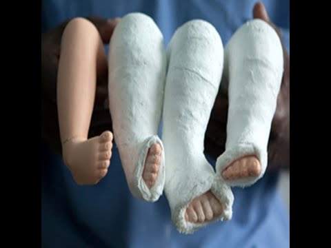 Ponseti technique for Clubfoot