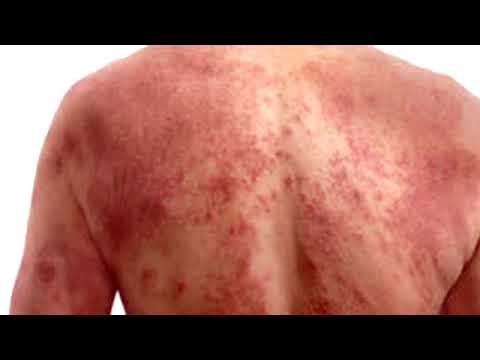 Die Diagnostik atopitscheskogo der Hautentzündung beim Kind Die Behandlung des Ekzems von wangi