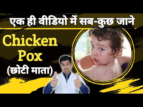 , title : 'चिकन पोक्स के लक्षण, कारण, उपचार और सावधानी | Chicken pox kaise thik hoga hai'