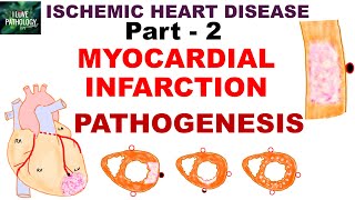 ISCHEMIC HEART DISEASE | part 2 |, Myocardial Infarction | Pathogenesis |Infarct Types