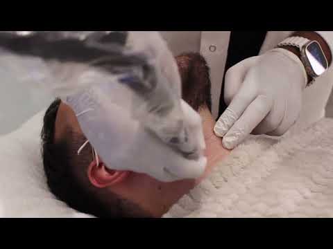Laser hair removal beard Clinica Medspa