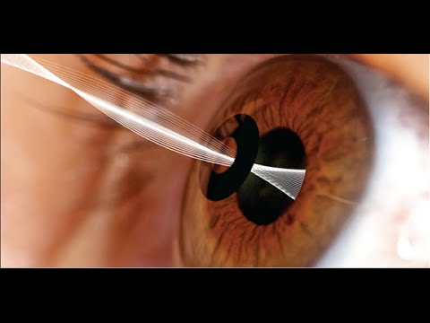 Dr Wang introduces new procedure for reading glasses