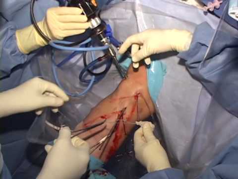 Medial Meniscus Transplant Surgical Technique