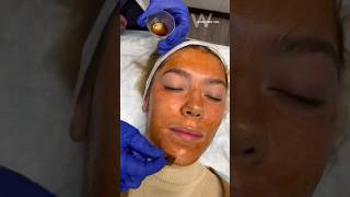 The VI Peel Purified Plus is used to minimize acne, scarring, and hyperpigmentation! #chemicalpeel