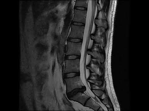 Reinigung der Gelenke Lorbeerblatt Schäden Zusammensetzungsmischung Petrova intravenös Zusammensetzung Osteochondrose