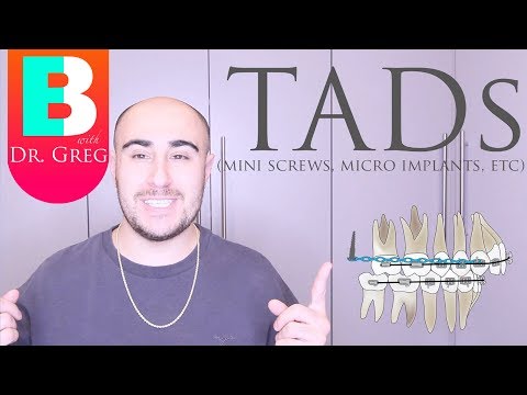 [BRACES EXPLAINED] TADs / Mini Implants Video