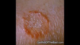 HOW TO - 4 Tips to Get Rid of Ringworm fast!