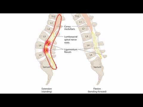 Lumbar Radiculopathy for the USMLE Step 1