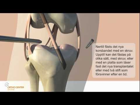 Främre korsbandsoperation Ortho Center Skåne