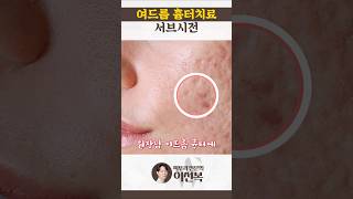 서브시전 성형 시술