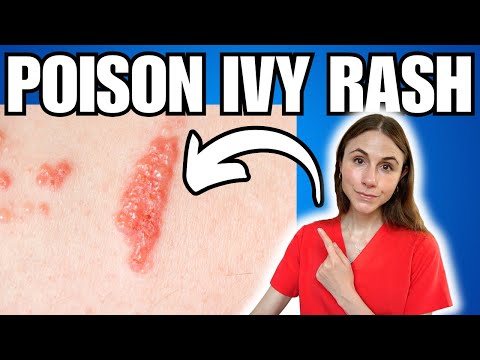 Get Rid Of Poison Ivy Rash FAST