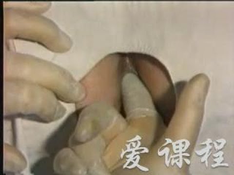 54.男性生殖器查体录像6 华西医学中心 诊断学