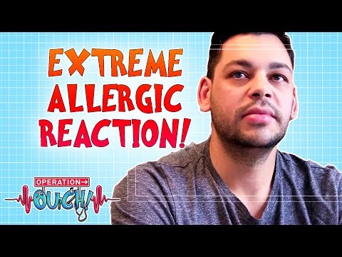 Allergic Reaction! | Operation Ouch | Science for Kids