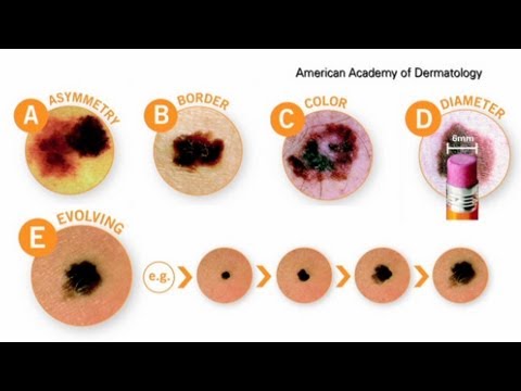 Know warning signs of melanoma