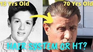 Sylvester Stallone Hair Transplant or Hair System Dr. Nakatsui Responds