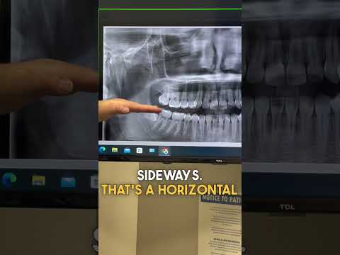 🚨 Do you have impacted wisdom teeth? Let’s talk about what it means… #wisdomteeth