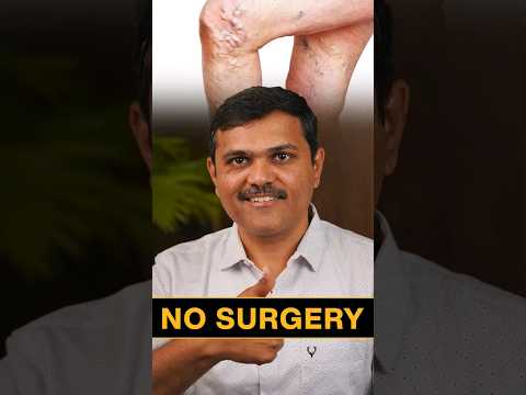 Treat Varicose Veins WITHOUT Surgery Experts Weigh In!