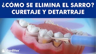 Tratamiento de la Periodontitis - Curetaje y Detartraje ©  - Clínica Dental Pardiñas