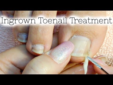 👣 Pedicure Tutorial Ingrown Toenail Treatment At Home How to Recut Nail Groove to Eliminate Pain