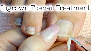 👣 Pedicure Tutorial Ingrown Toenail Treatment At Home How to Recut Nail Groove to Eliminate Pain