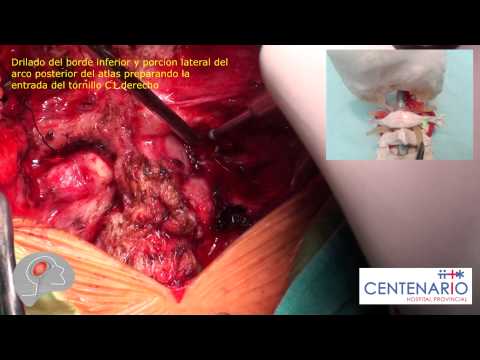 Los efectos de la cadera pies planos Osteocondrosis rodilla conjunta popular