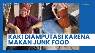 Kisah Wanita Kehilangan Sebelah Kakinya: Terlalu Banyak Konsumsi Junk Food saat Sekolah