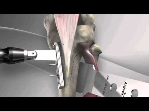 Transpozitia tuberozitatii tibiale