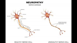Traumatic Neuropathy; erve damage caused by physical injury, leading to pain, weakness,