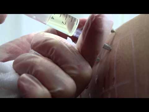 Klinik in Moskau Behandlung von Osteoarthritis des Knies Wenn ein wunder Hals an der Basis des Schädels hinter