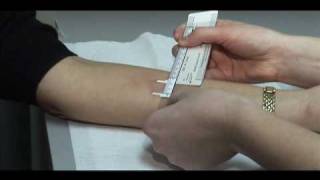 TB Skin Test - Mantoux Method