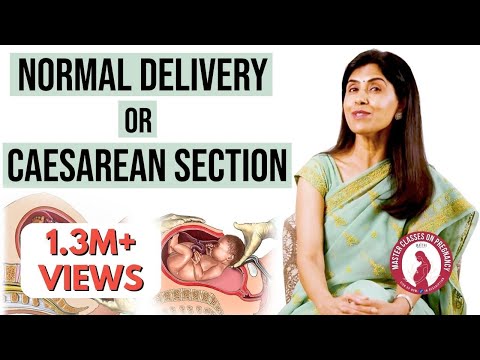 Normal Delivery or C-Section