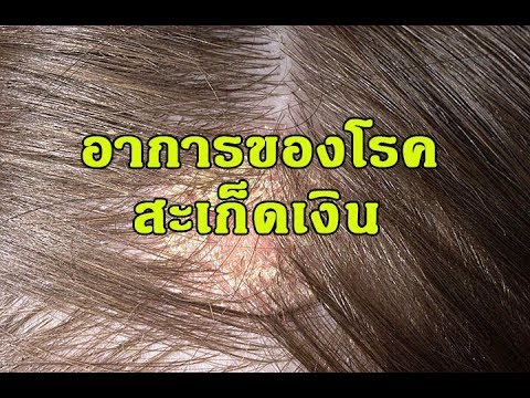 โรคสะเก็ดเงินครีม tsitopsor กับไขมัน ครีมกลากกับ Naftalan