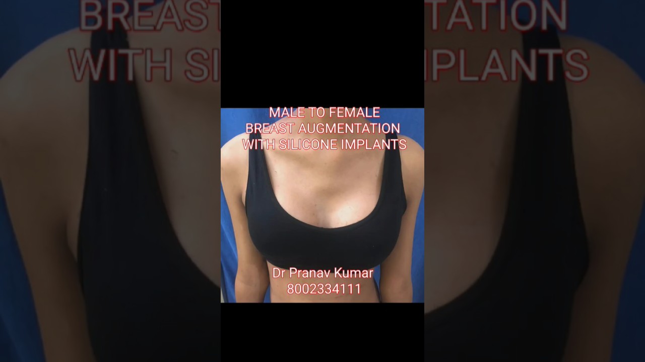 #maletofemaletransformation #breastaugmentation #siliconeimplants - Dr Pranav Kumar Plastic Surgeon