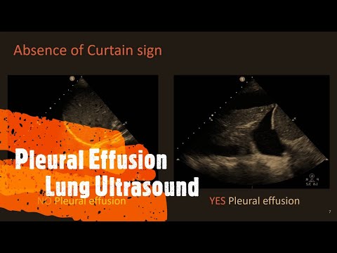 Pleural Effusion Lung Ultrasound. Perioperative & Critical Care POCUS
