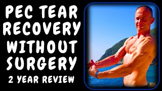 How I Recovered From A Pec Tear Without Surgery | My 2 Year Review