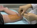 Implanon Insertion