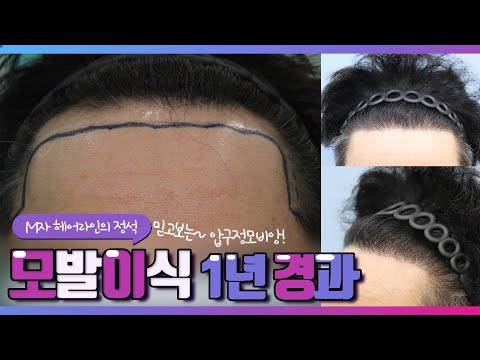 30대후반 남성,비절개 3600모, M자 모발이식 1년 경과영상!